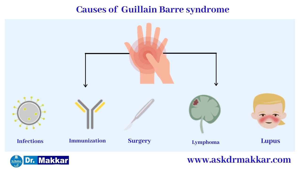 Guillain Barre Syndrome,GBS,Symptoms,Causes Of Guillain Barre Syndrome ...